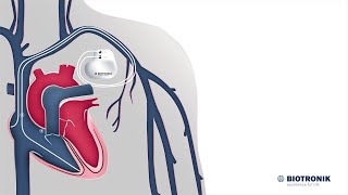 Comment fonctionnent les stimulateurs cardiaques  Animation médicale [upl. by Mina36]