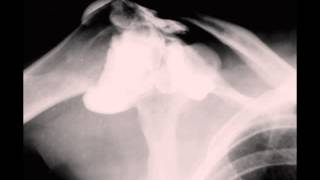 Rotator Cuff Tear on Shoulder Arthrogram [upl. by Cloutman]