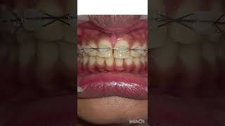 Closing midline diastema with ceramic braces shorts [upl. by Ahsikar945]