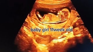 Baby girl 11weeks old ultrasound baby babygirl healthybaby subscribe my channel for more video [upl. by Alyworth]