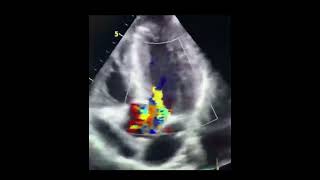 Aortic valveechocardiography heartcondition heartdoctor SafaMedicalLecture [upl. by Rabbaj]