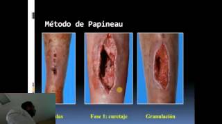 Osteomielitis Crónica [upl. by Atiek]