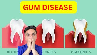 Gingivitis Vs Periodontitis Watch This Before It is TOO LATE [upl. by Haden263]