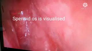 MEDIAL APOROACH TO SPHENOID SINUS  ISOLATED SPHENOID SINUSITIS RIGHT SIDE [upl. by Rik]