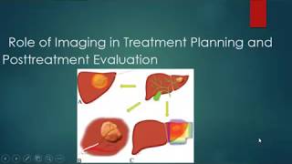 9post ablation of hepatic focal lesion [upl. by Ravid462]