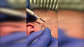 Seborrhoeic Keratosis Removal Demo [upl. by Egduj]