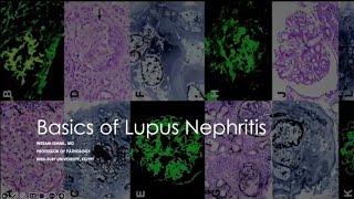 Basics of lupus nephritis pathology for clinicians Prof Wesam Ismail Head of pathology department [upl. by Cornish]