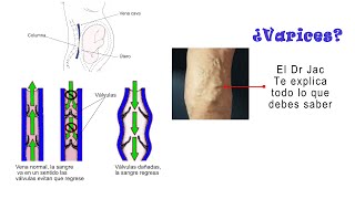 Venas varicosas o varices [upl. by Ahsinyt]