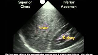 Anleitung FASTUntersuchung des rechten Oberbauchs – normale Untersuchung [upl. by Hussar]