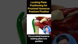 Optimal Locking Plate Positioning for Proximal Humerus Fracture 근위 상완골 골절 고정을 위한 최적의 잠김판 위치 [upl. by Harcourt]