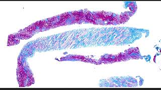 Collidescope Ep 1  What happens when IgA nephropathy and fibrillary glomerulopathy collide [upl. by Marabel]