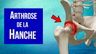 Arthrose de la hanche  Explication et Traitement [upl. by Ecidna]