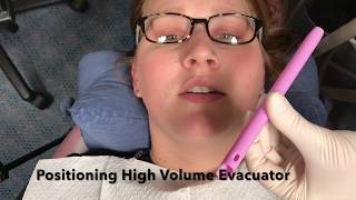 Positioning High Volume Evacuator [upl. by Brennen558]