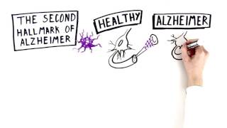 Alzheimers Disease The Basics  Being Patient [upl. by Neerual]