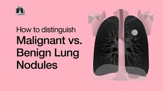 Distinguish Malignant vs Benign Lung Nodules [upl. by Aiki921]