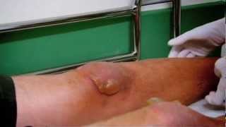 Burn Blisters  Part 1  Bizarre ER [upl. by Witty653]