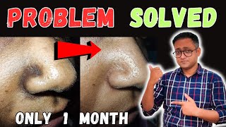 Black spots around nose  Permanent cure  Dr Supratim Saha [upl. by Ymrots]