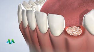 Socket Preservation in Flint MI  Greater Michigan Oral Surgeons amp Dental Implant Center [upl. by Marcile423]