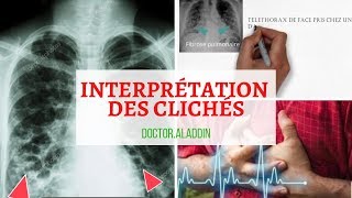 Pneumonie  Maitriser linterprétation des clichés [upl. by Esinereb]