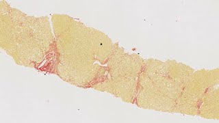 HISTALIM Chronic diseases  Hepatic fibrosis collagen quantification on human liver [upl. by Sjoberg]