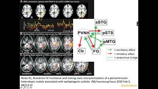 7 Heterotopia epilepsy PVNH malformation cortical development filamin CDK5 MRI neuroradiology [upl. by Scotti]