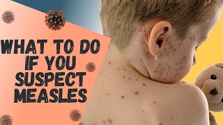 What Every Adult and Child MUST Do If You Suspect MEASLES [upl. by Revolc]