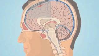 Understanding Subarachnoid Hemorrhage [upl. by Pohsib]