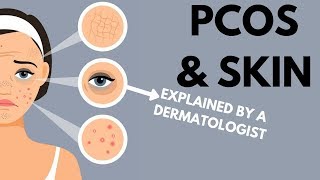 PCOS amp Skin  Dermatologist Review [upl. by Ianej]