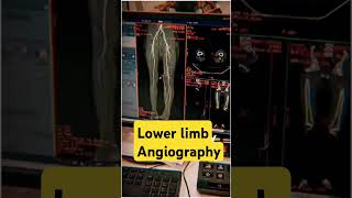 Lower limb angio VRT images vrt angiogram 3d ctangiography ctscan angiography anatomy [upl. by Kris]