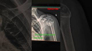 Proximal humerus fracturexray subscribe support ytshorts viralshorts [upl. by Anih]