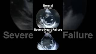 Echocardiogram NORMAL vs SEVERE HEART FAILURE radiology cardiology [upl. by Harrie392]