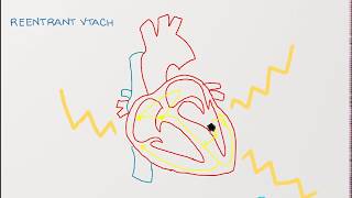 Ventricular Tachycardia  Types Causes and Treatment Approaches [upl. by Miuqaoj]