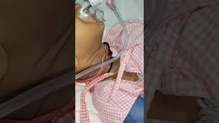 pneumonia kafi serious nursing doctor shortsvideo yourubeshorts doctorlife medico [upl. by Naawaj]