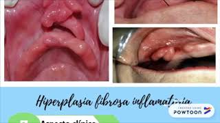 Hiperplasia papilar inflamatoria e hiperplasia fibrosa inflamatoria [upl. by Leatrice180]