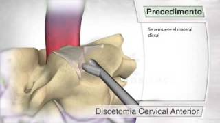 Disectomía cervical anterior [upl. by Neetsyrk]