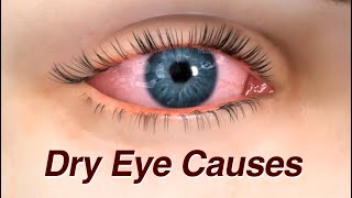 Dry Eye Causes and Treatment [upl. by Ytitsahc]