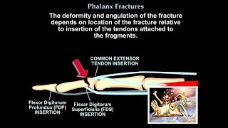 Phalanx Fractures  Everything You Need To Know  Dr Nabil Ebraheim [upl. by Langan]