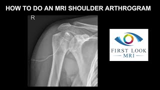 How to do an MRI shoulder arthrogram [upl. by Troth]