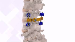 VTI InterLink™ Pedicle Screw Surgical Technique [upl. by Moreland229]