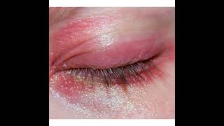 Blepharitis Symptoms and Causes  Diagnosis  Treatment  Prevention health [upl. by Adaminah801]