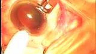 John Hovanesian MD Limbal Relaxing Incision Astigmatism [upl. by Awahsoj377]