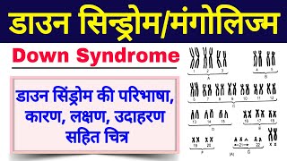 डाउन सिंड्रोम क्या है  down syndrome in hindi class 12 biology  down syndrome ke lakshan Mongolism [upl. by Isle]