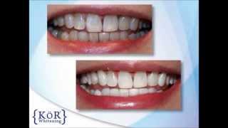 Smiles4OC KOR Whitening video [upl. by Harrod]