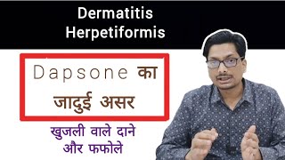 Dapsone का जादुई असर  Dermatitis Herpetiformis खुजली वाले दाने और फफोले Dapsone itchingtreatment [upl. by Olra]