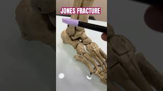 Jones fracture orthopedics hospital bestorthodoctor foot doctorabin doctor 24newslive [upl. by Ruddie475]