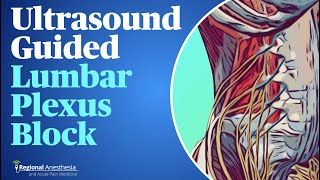 UltrasoundGuided Lumbar Plexus Block [upl. by Ellynad]