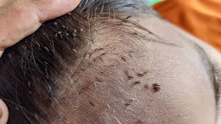 Remove all big lice from his hair  How to remove all hundred lice from his head [upl. by Jerz]