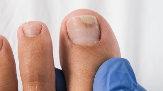 How to regrow a separated toenail Watch this ASAP [upl. by Chemarin]