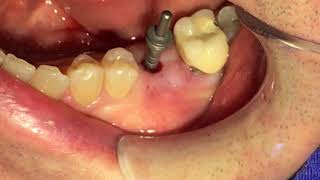 FLAPLESS IMPLANT Implante dental con una técnica sin colgajo [upl. by Kieffer]