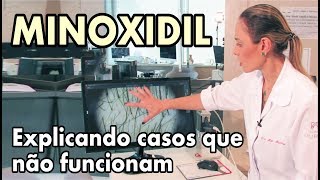 MINOXIDIL  Explicando casos que não funcionam [upl. by Annaerda]